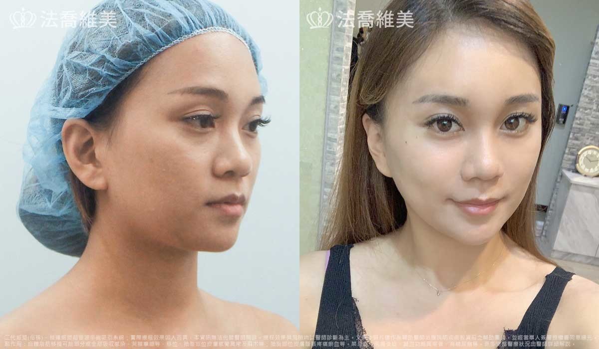 高雄法喬醫美,邱浚彥,威塑抽脂,自體脂肪豐臉