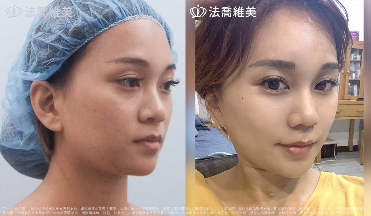 高雄法喬醫美,邱浚彥,威塑抽脂,自體脂肪豐臉
