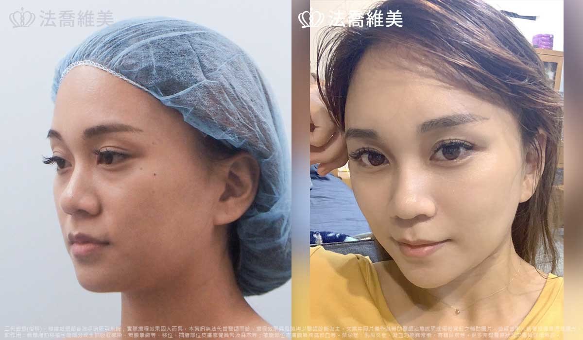 高雄法喬醫美,邱浚彥,威塑抽脂,自體脂肪豐臉