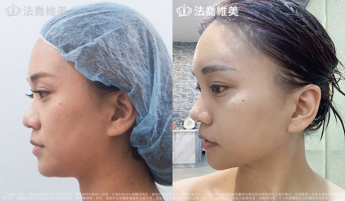 高雄法喬醫美,邱浚彥,威塑抽脂,自體脂肪豐臉