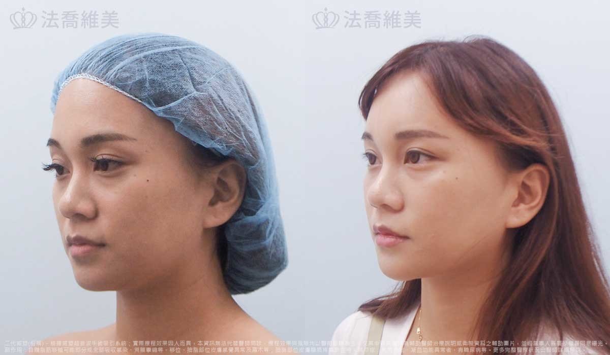 高雄法喬醫美,邱浚彥,威塑抽脂,自體脂肪豐臉