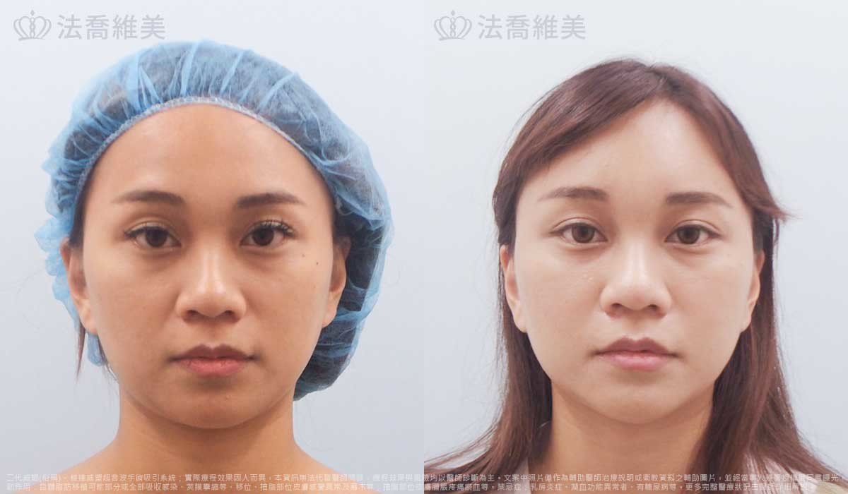 高雄法喬醫美,邱浚彥,威塑抽脂,自體脂肪豐臉