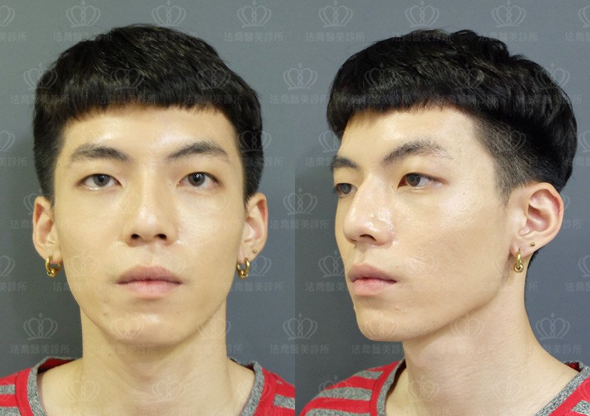 法喬醫美皮秒雷射PICOCARE