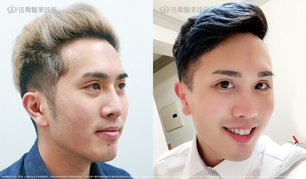 PICOCARE皮秒雷射