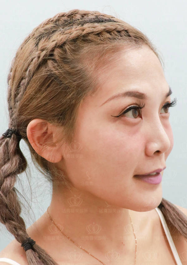 /files/images/案例分享/皮秒雷射/李李涵/術前_正面.jpg?1568946846 法喬醫美診所_皮秒雷射PICOCARE