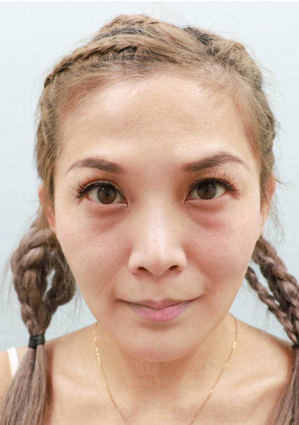 /files/images/案例分享/皮秒雷射/李李涵/術前_左側.jpg?1568946847 法喬醫美診所_皮秒雷射PICOCARE