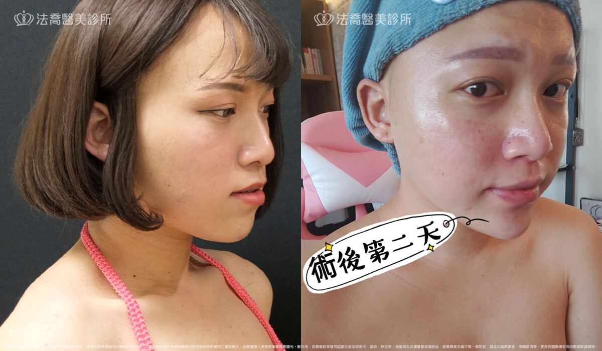  PICOCARE 皮秒雷射  術後第二天