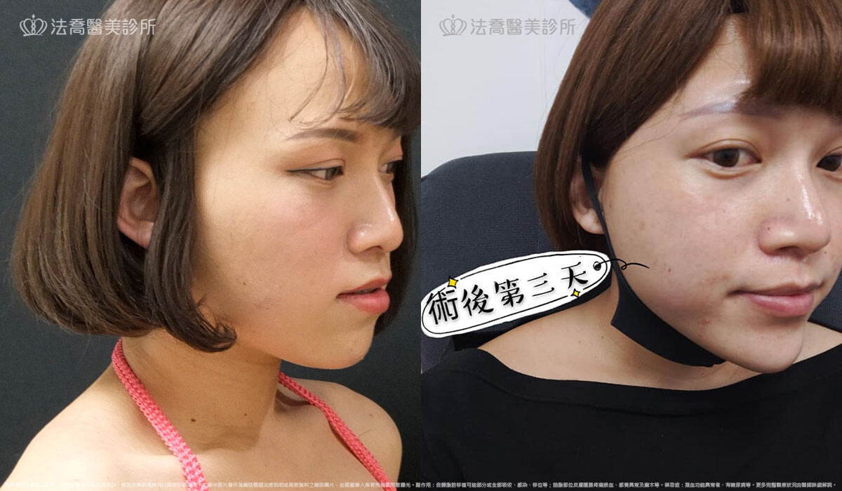  PICOCARE 皮秒雷射  術後第三天