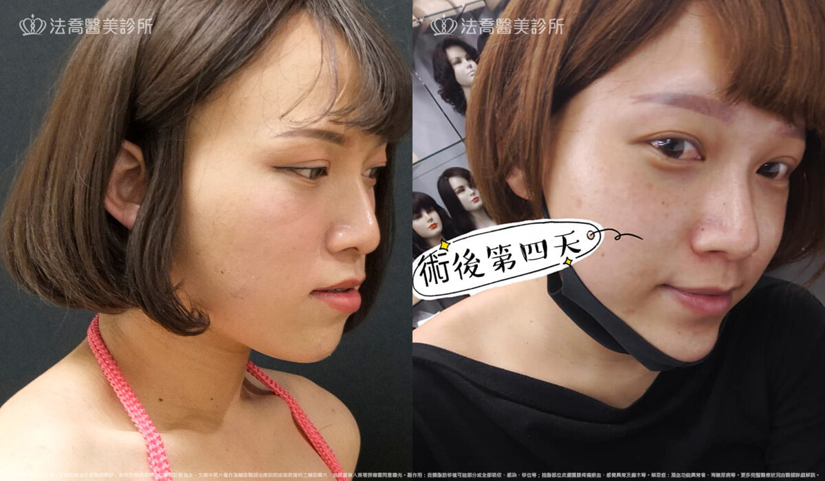  PICOCARE 皮秒雷射  術後第四天