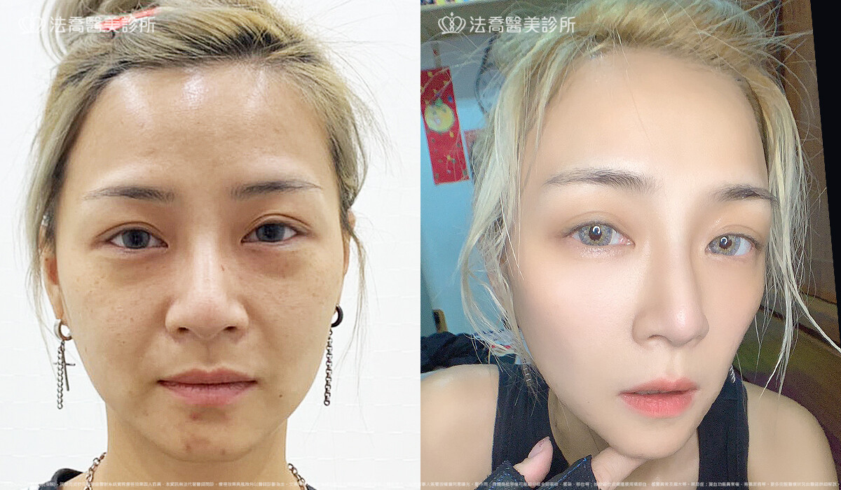 PICOCARE 皮秒雷射 術後一個月