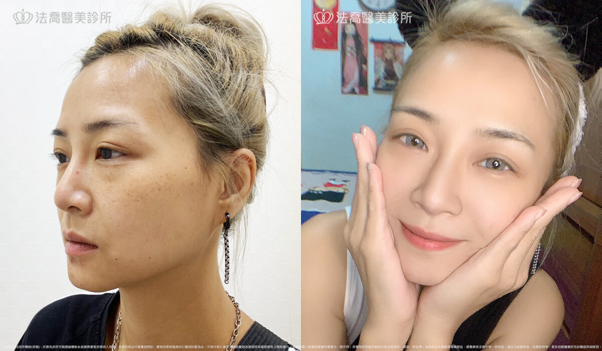 PICOCARE 皮秒雷射 術後1個月