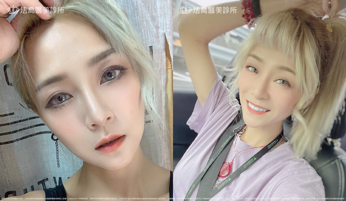 皮秒雷射 術後生活照