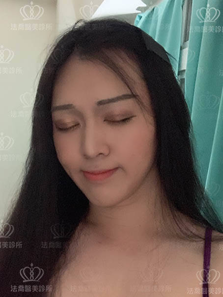 法喬醫美皮秒術後案例