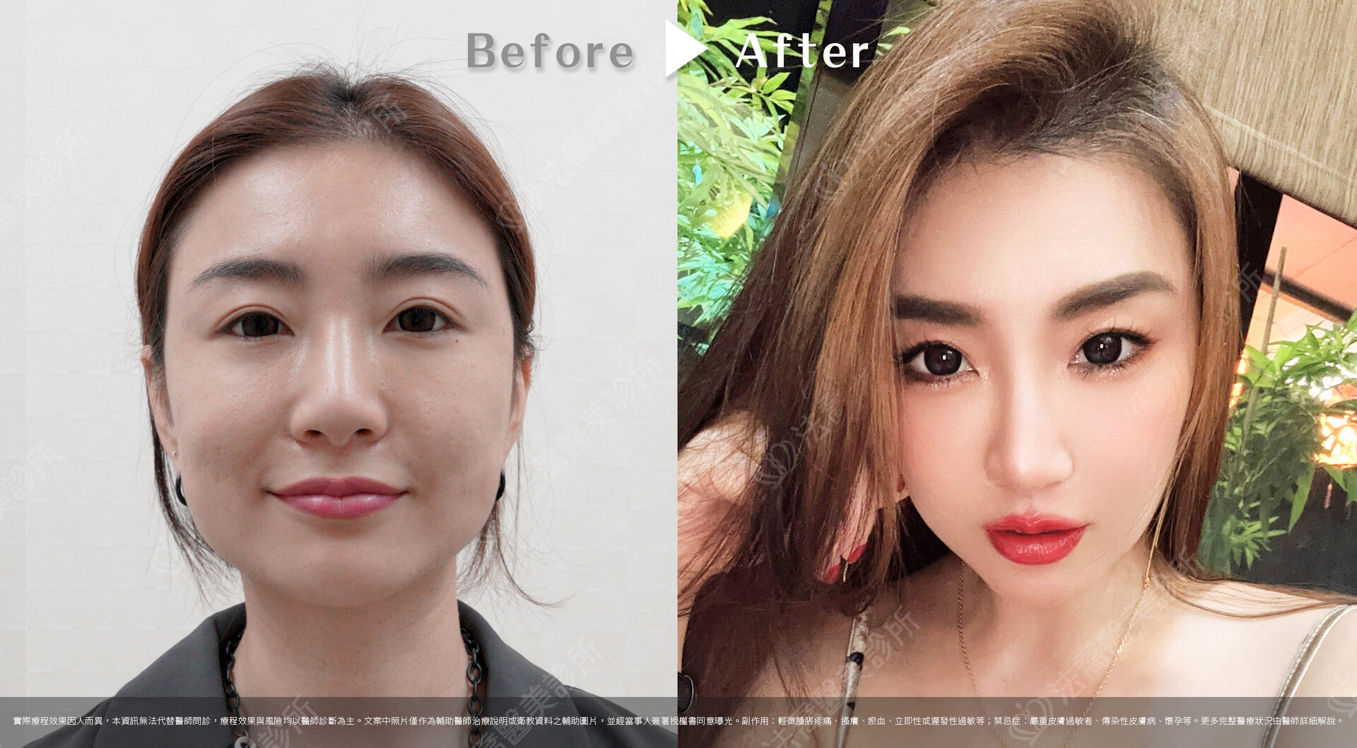  PICOCARE 皮秒雷射  術前術後