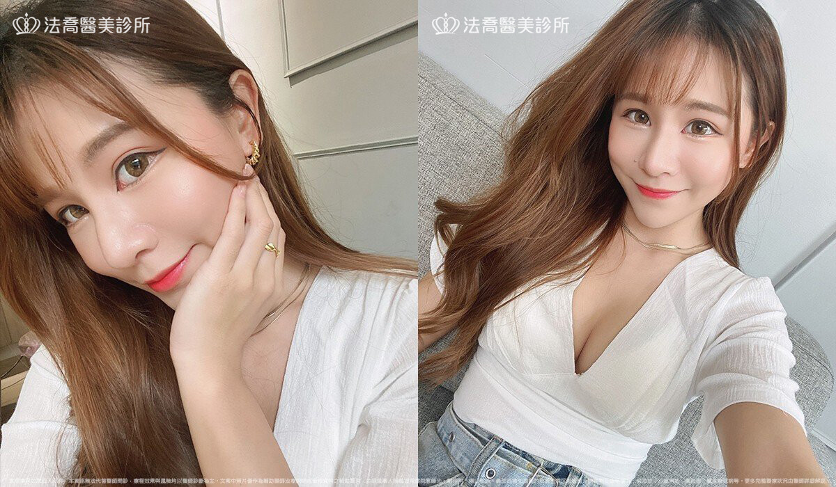 法喬醫美診所,邱浚彥,自體肋骨隆鼻