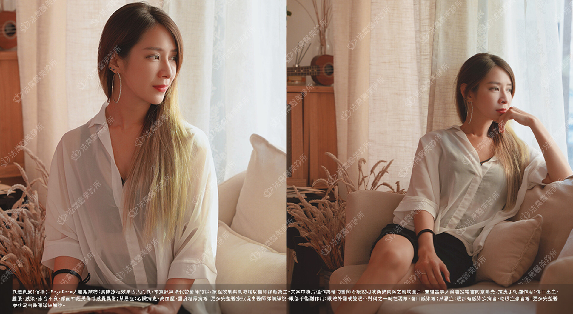 眼袋內開、脂肪移位  術後4個月