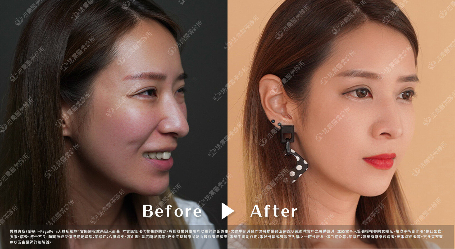 異體真皮鼻唇溝(法令)填補術  術前與術後3個月