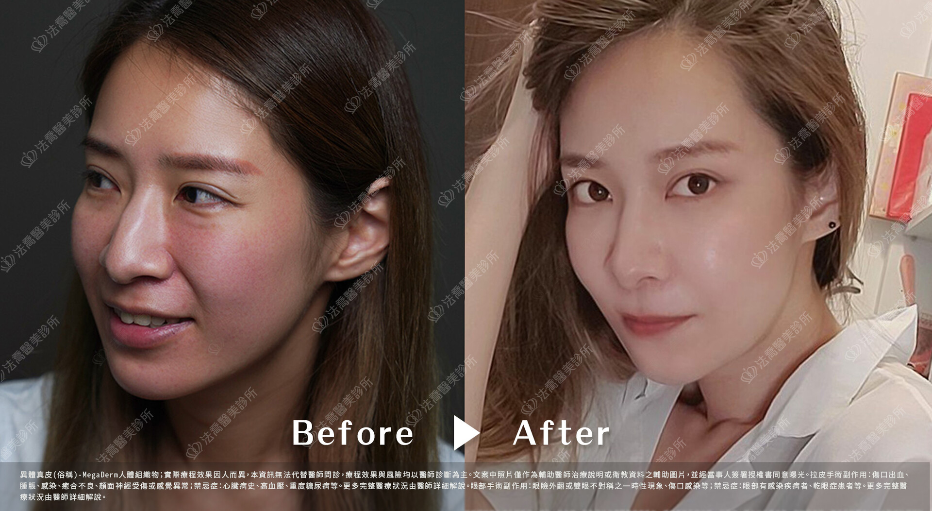 異體真皮鼻唇溝  術前與術後1個月