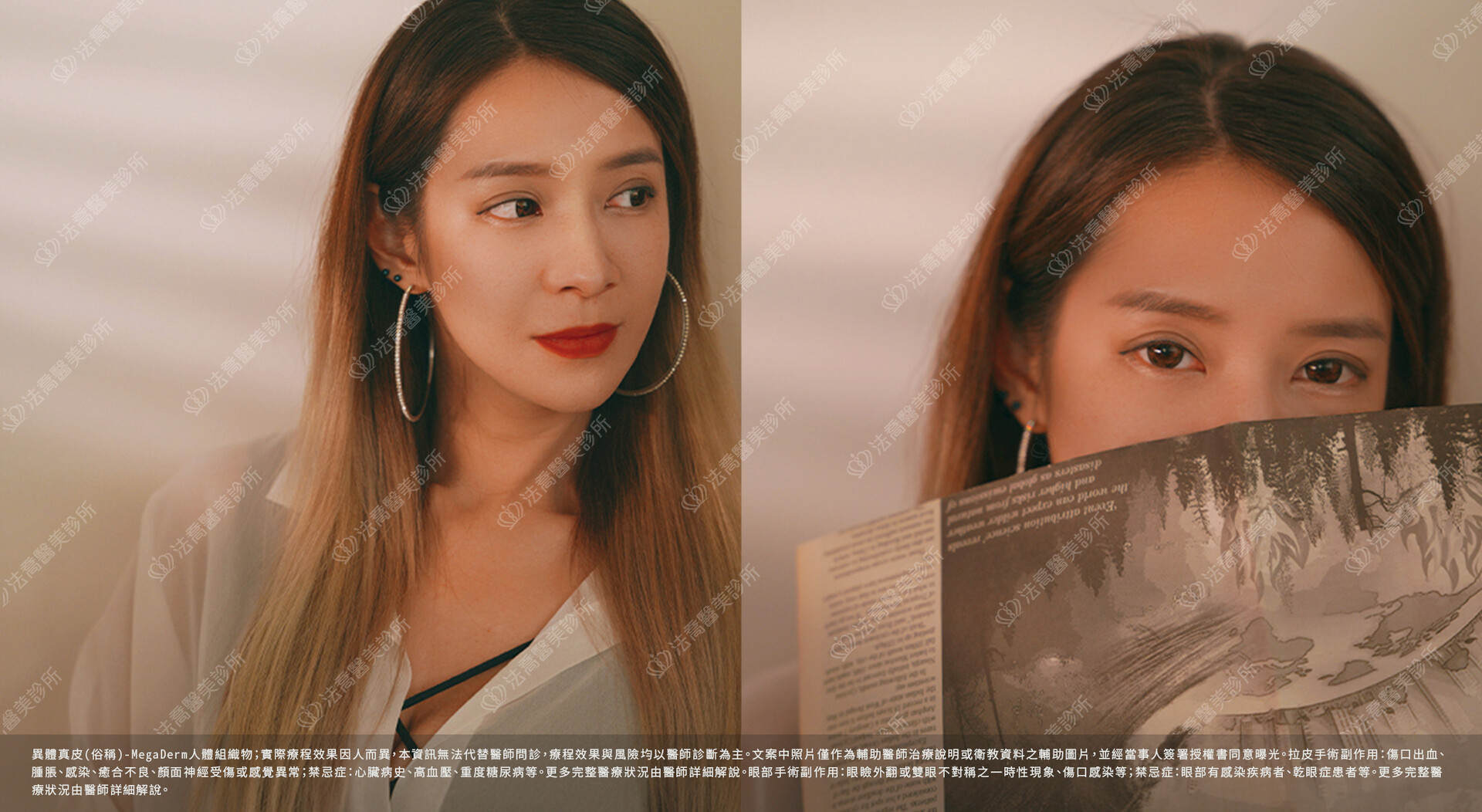 眼袋內開、脂肪移位 / 術後3個月