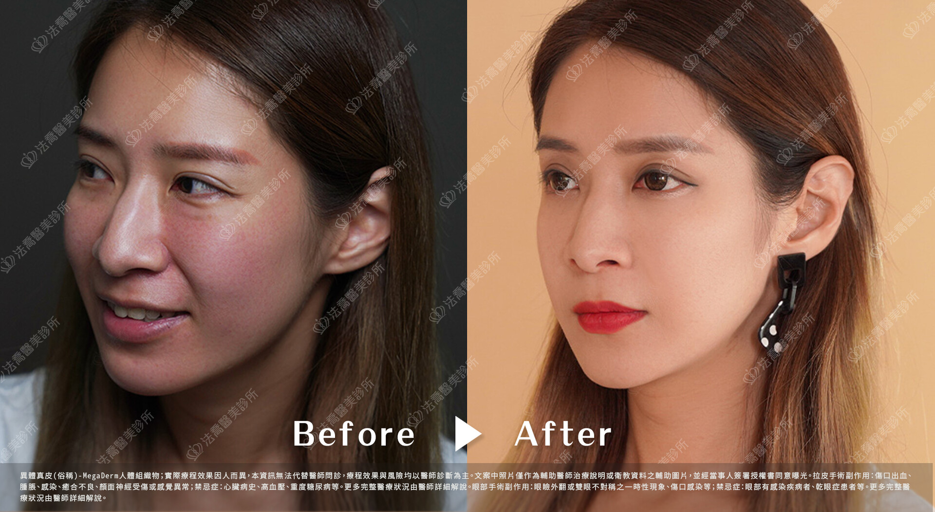 異體真皮鼻唇溝(法令)填補術  術前與術後3個月