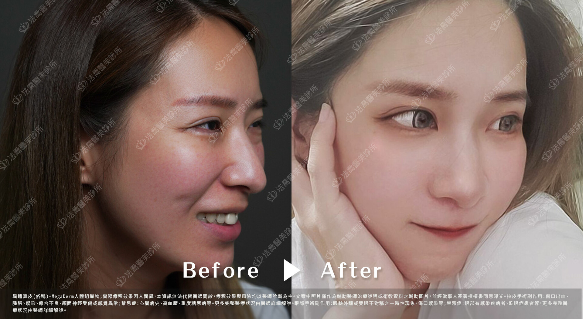 異體真皮鼻唇溝  術前與術後1個月