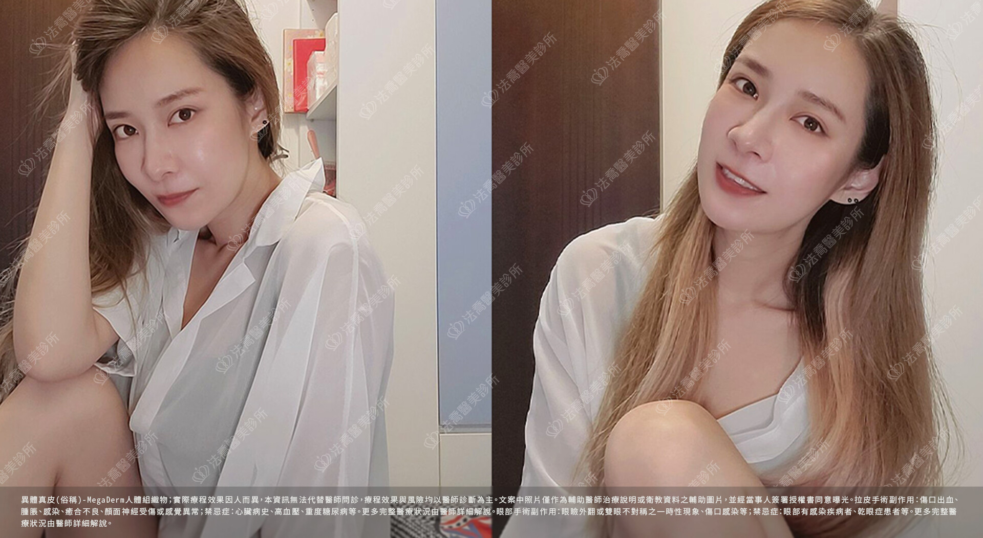 眼袋內開 脂肪移位  術後一個月 生活照