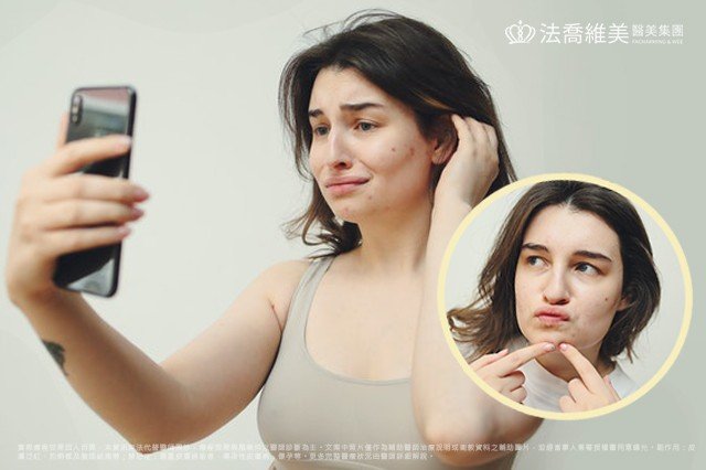 擠青春痘示意圖