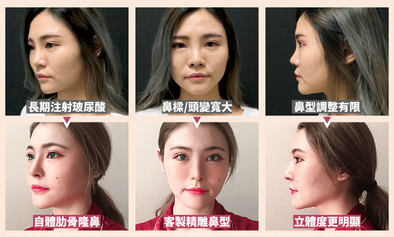 為何有人注射玻尿酸後鼻子變寬？