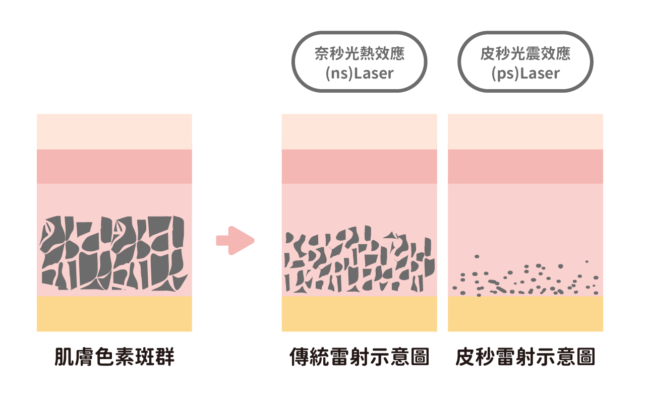 皮秒雷射與傳統雷射比較