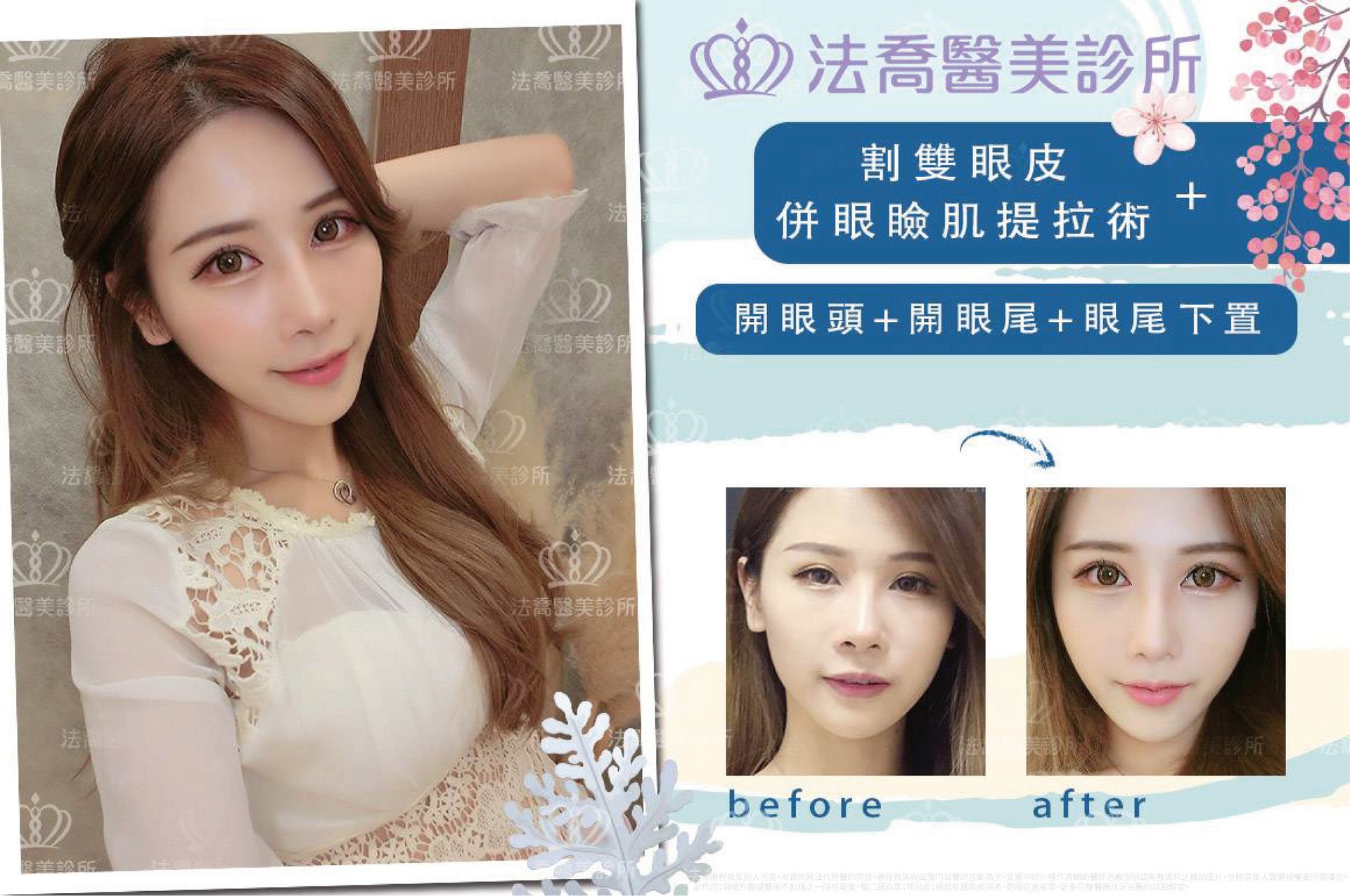 法喬邱浚彥割雙眼皮提眼肌開眼頭開眼尾眼尾下置