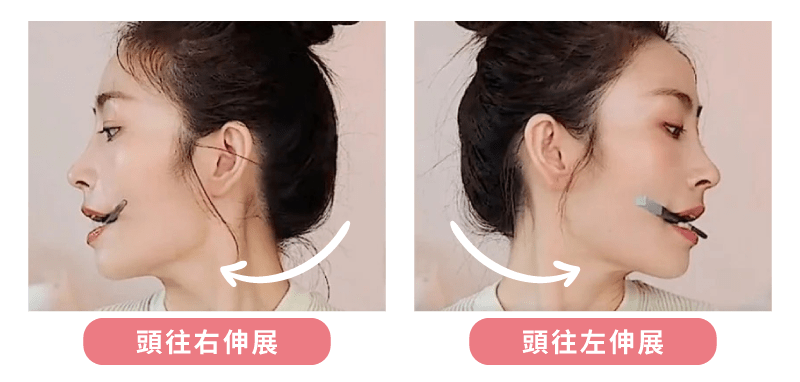 改善臉不對稱下顎線