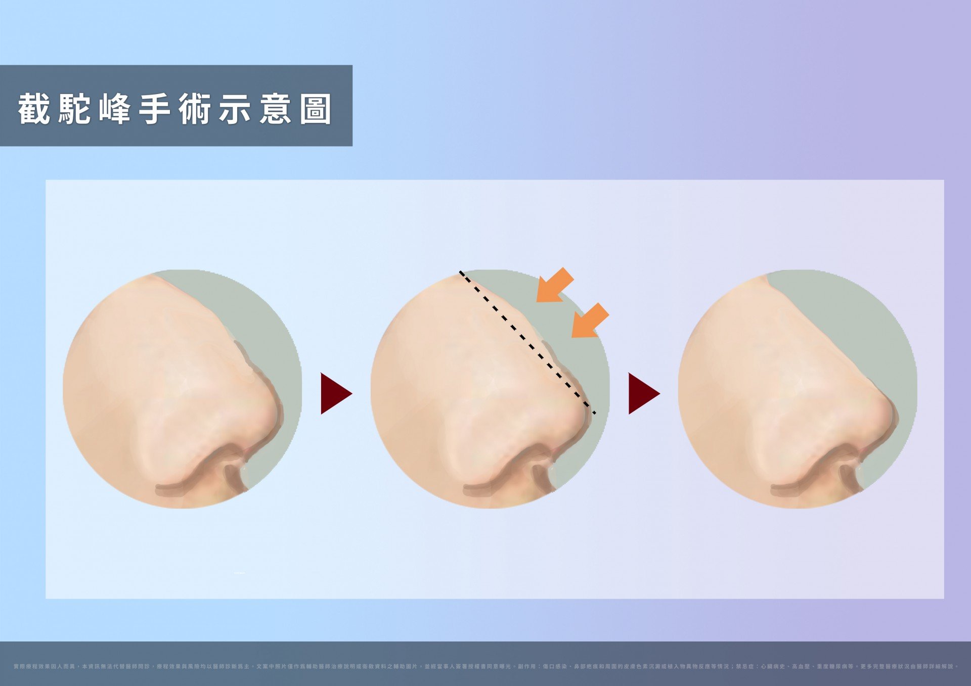截駝峰