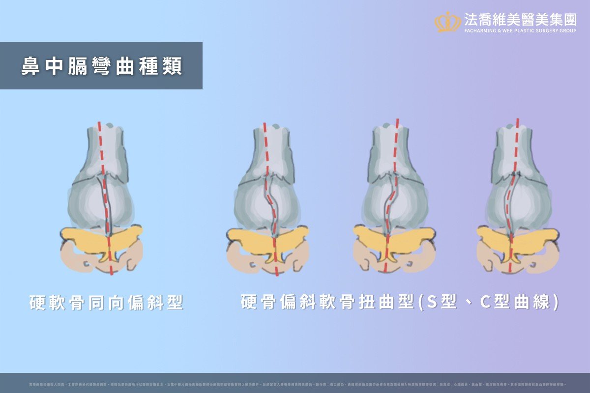 鼻中膈彎曲