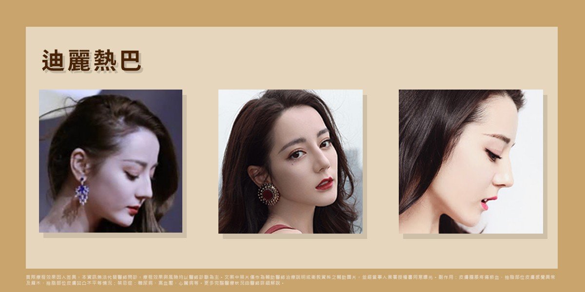 迪麗熱巴的駝峰鼻