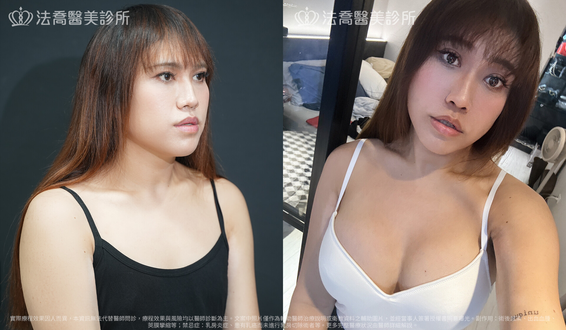 李兒自體肋骨隆鼻