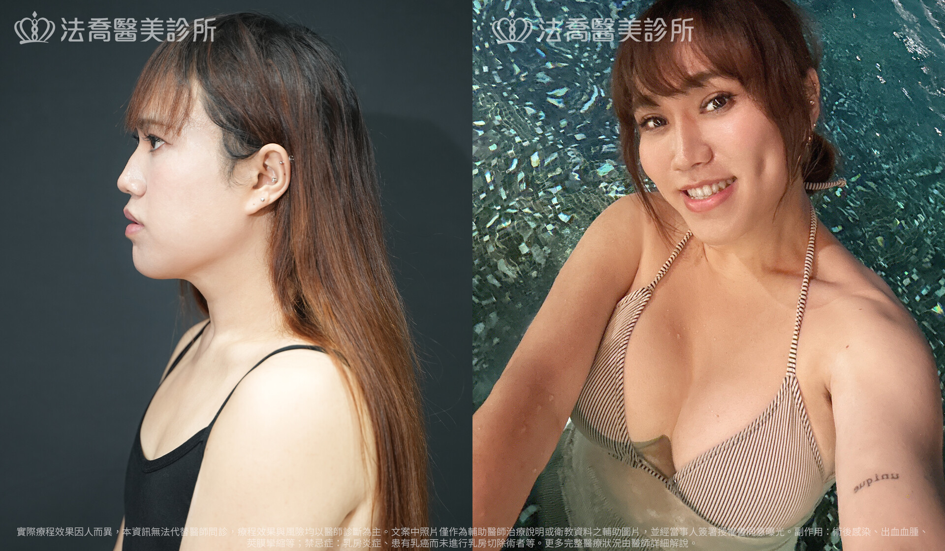 李兒自體肋骨隆鼻